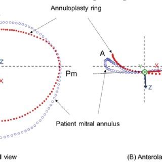 Alignment of the annuloplasty ring and the patient mitral annulus ...