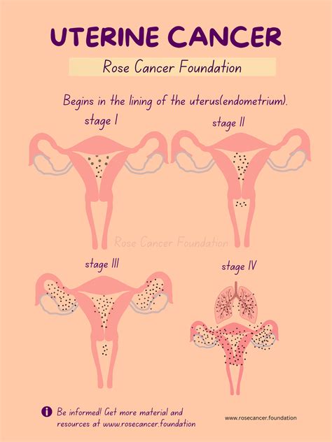 Uterine/Endometrial Cancer