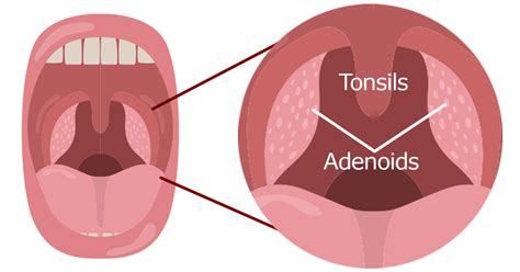 Tonsils and Adenoids - Alabama Nasal and Sinus Center, Birmingham, AL, ENT