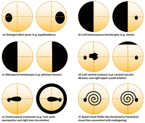 Community Eye Health Journal » Visual field testing for glaucoma – a practical guide