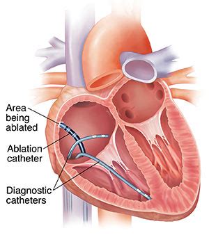 Ablation | St. Mark's Hospital