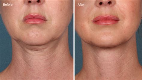 Laser Skin Tightening: How It Works, Results, Risks and Cost