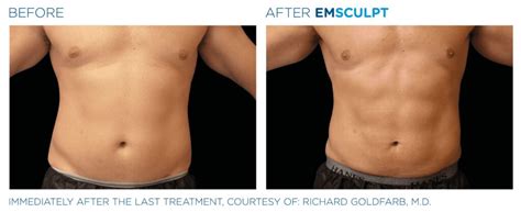 Emsculpt NEO Before and After Pictures - Cunningham Clinic