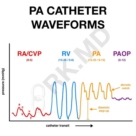 Pulmonary Artery Catheter/Swan-Ganz Structure And Waveforms | RK.MD