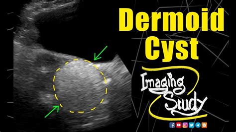 Dermoid Cyst || Ultrasound || Case 164, 57% OFF