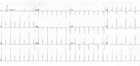 Pacemaker Rhythms – Normal Patterns • LITFL • ECG Library Diagnosis