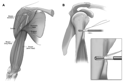 Biceps Tenodesis Procedure