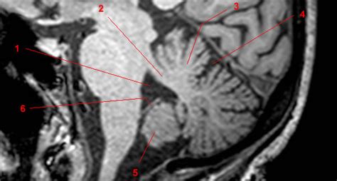 Cerebellum: anatomy and MRI