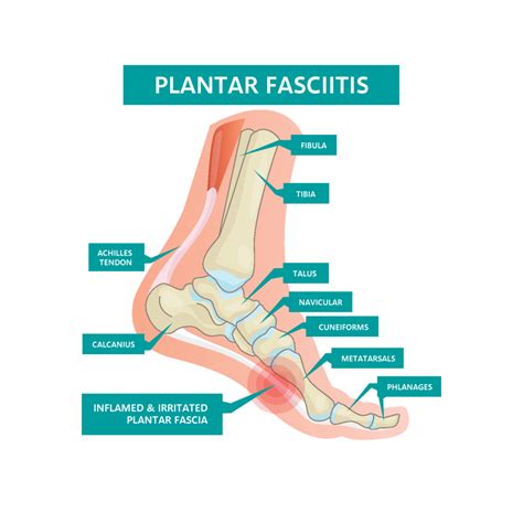 plantar fasciitis diagram • Liz Tough Clinic