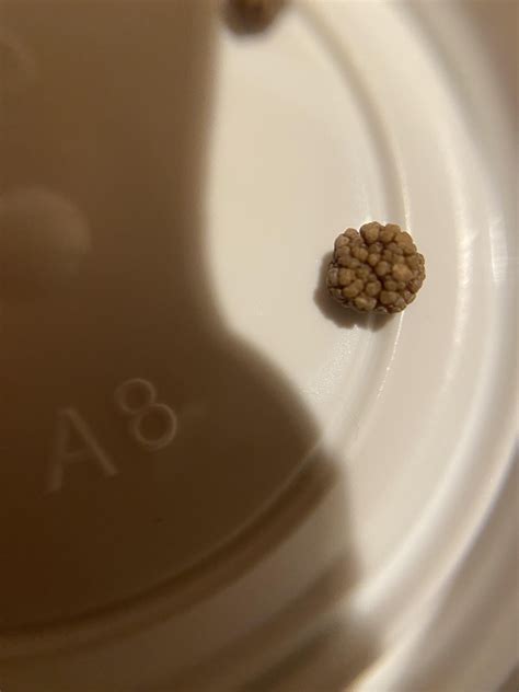 7mm kidney stone surgically removed, also had a 5mm taken out too. : r/KidneyStones