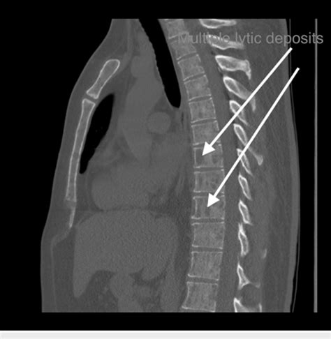 Lytic Bone Lesions Differential