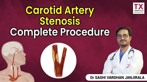 Carotid Artery Stenosis Procedure Explained by DR.Shasi Janjirala || TX ...