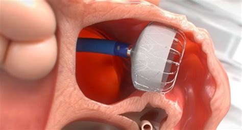 FDA Approves Next-Generation Watchman FLX Device for LAA Occlusion ...