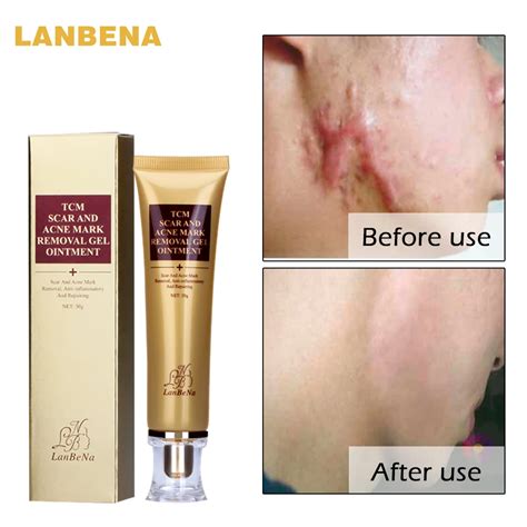 LANBENA Acne Scar Removal Cream Skin Repair Face Cream Acne Spots Acne Treatment Blackhead ...