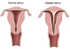 Uterine Septum - Manhattan Women's Health and Wellness Gynecology