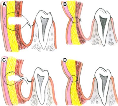 Dimpleplasty In Korea - What is it and how does it work? - Seoul Guide Medical