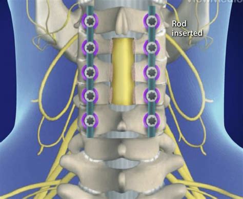 Laminectomy Procedure | What does a Laminectomy Procedure look like