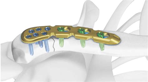 Orthopedic Implants Manufacturer: Orthopedic Implants in Malaysia