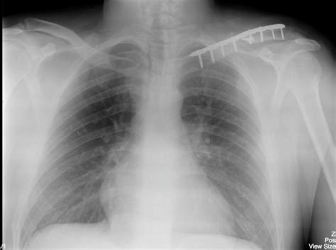 Clavicle Fracture – Undergraduate Diagnostic Imaging Fundamentals