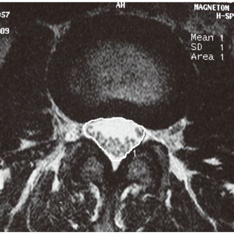 Magnetic resonance image showing thecal sac measuring 80 mm2 at L5-S1 ...