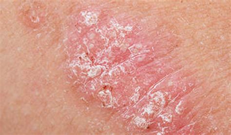 PSORIASIS – Dermatology Conditions and Treatments