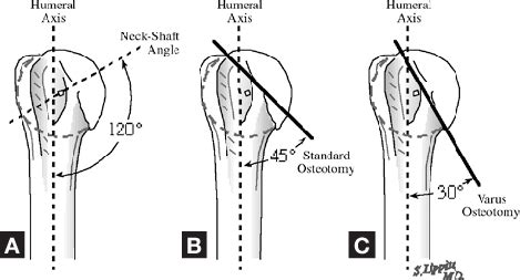 Humeral Anatomy - Anatomical Charts & Posters