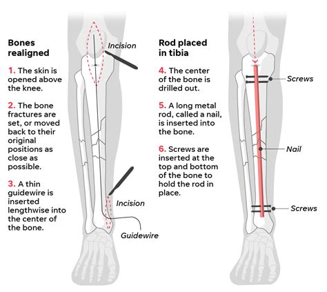 Tiger Woods' leg injury: His recovery, return to 2022 Masters, Augusta