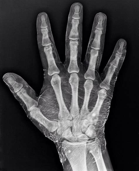 X-ray of a hand dipped in iodine. Iodine absorbs X-rays, revealing the ...