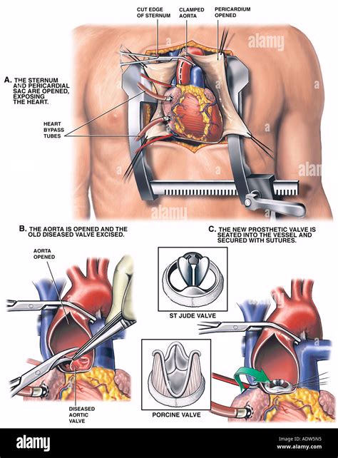 Heart Surgery Aortic Valve Replacement Stock Photo 7712020 Alamy