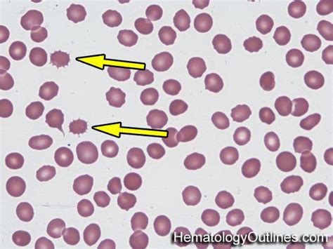 HematologyOutlines - Glossary | Hematology, Blood groups, Blood disorder