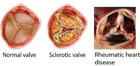 Causes of Aortic regurgitation: Summary - Critical Care Sonography