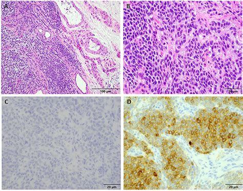 Images showing histopathological analysis of adult granulosa cell... | Download Scientific Diagram