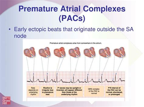 PPT - Atrial Dysrhythmias PowerPoint Presentation, free download - ID:6165537