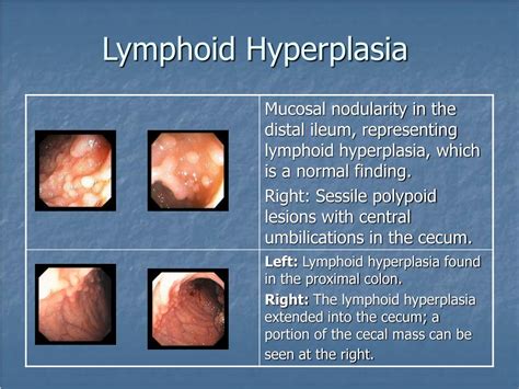 Benign Lymphoid Hyperplasia