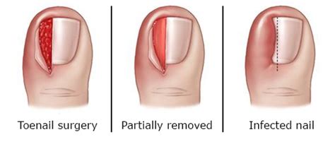 Ingrown Toenail - OrthoInfo - AAOS