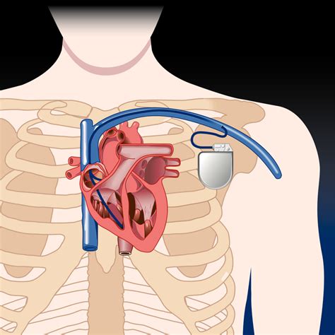 Heart Pacemaker - What Is It? Frequently Asked Questions - Dr Vivek Baliga, Internal Medicine ...