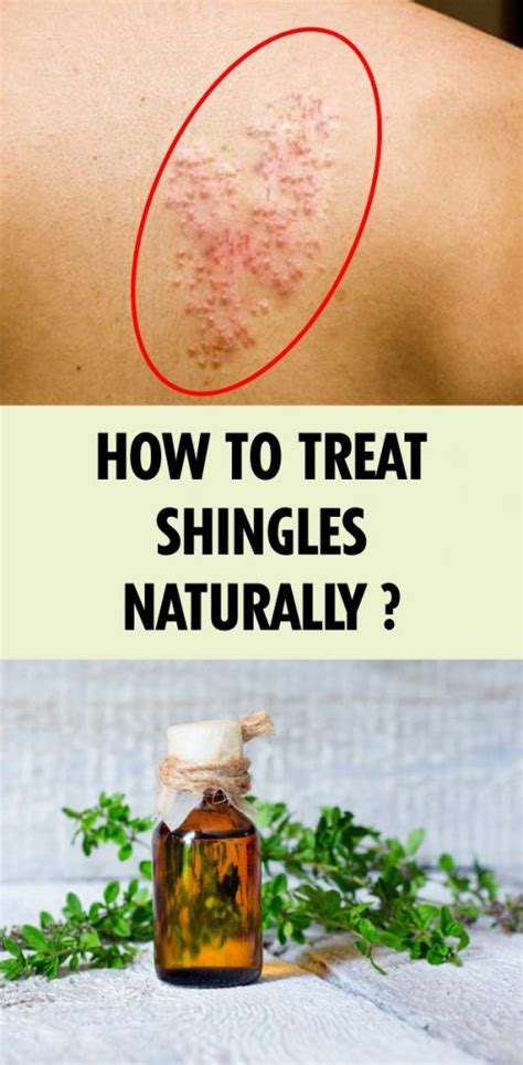 How To Treat Shingles Naturally ? | Natural rash remedies, Shingling ...