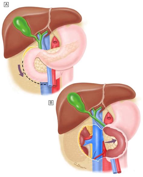 Dr Luis Felipe Cabrera Vargas MD FACS MACC MACCVA on Twitter: "Step 👟 by step 🥾 : The Kocher ...