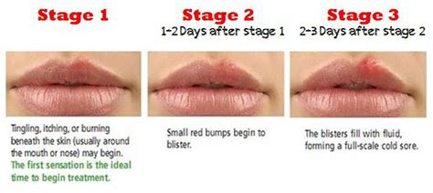 Herpes symptoms and stages