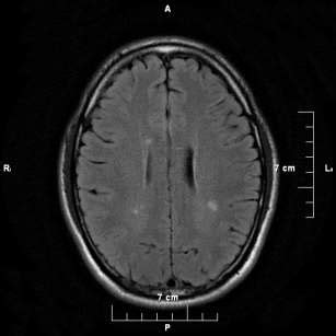 Axial T2-FLAIR brain MRI. Bilateral periventricular hyperintense lesions | Download Scientific ...