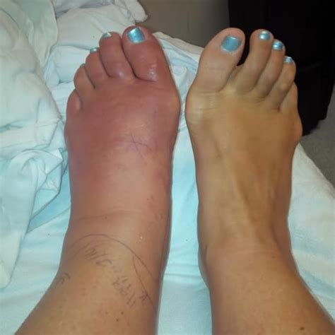 Woman develops potentially life-threatening infection after pedicure in ...