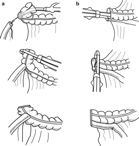 Schematic diagram of the anastomosis methods A. End-to-side anastomosis... | Download Scientific ...