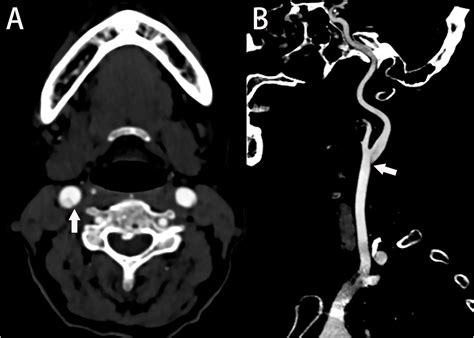 Frontiers | The carotid web: Current research status and imaging features