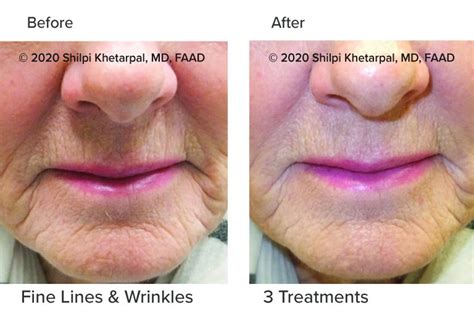 microneedling-results-05 - Colorado Dermatology Mohs Surgery