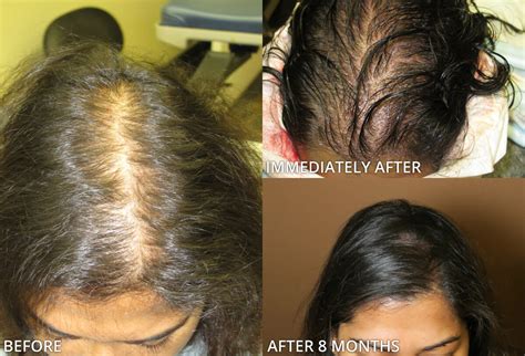 Female Hair Transplant – Before and After Pictures * | Dr Turowski - Plastic Surgery Chicago