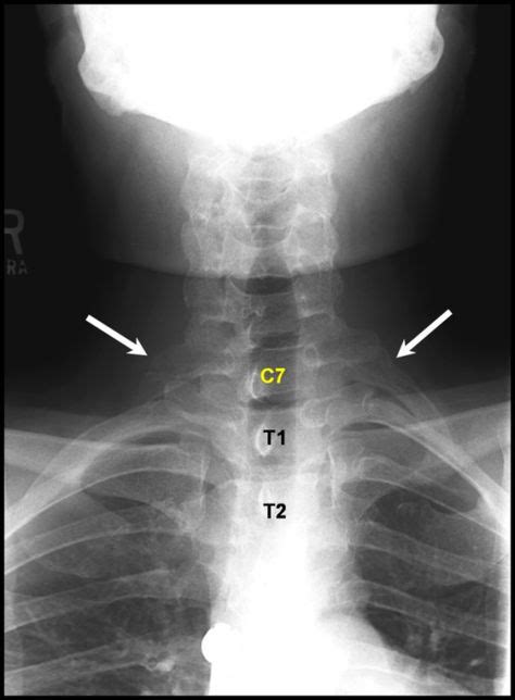 cervical rib | Radiology, Cervical, Radiography