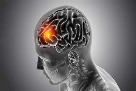 What Diseases Can Cause Lesions On The Brain? What Is The Most Common Cause Of Lesions In The ...