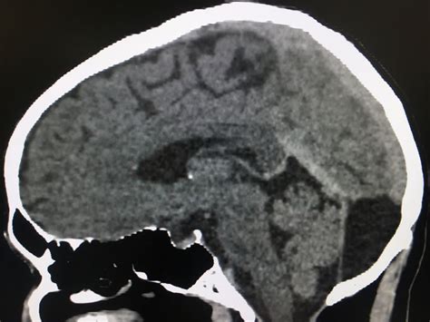 Mega cisterna magna Vs Retrocerebellar Arachnoid cyst | Radiology