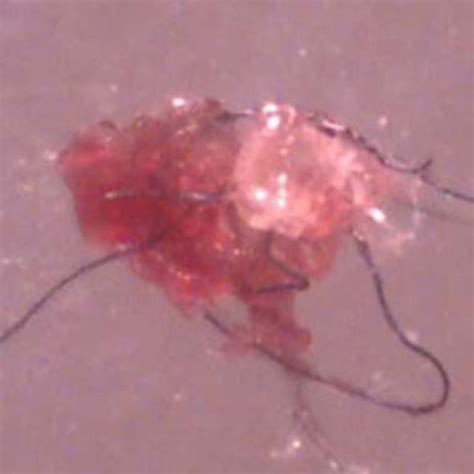 What is Morgellons Disease? Is it a physical or psychological condition? - Scientific American