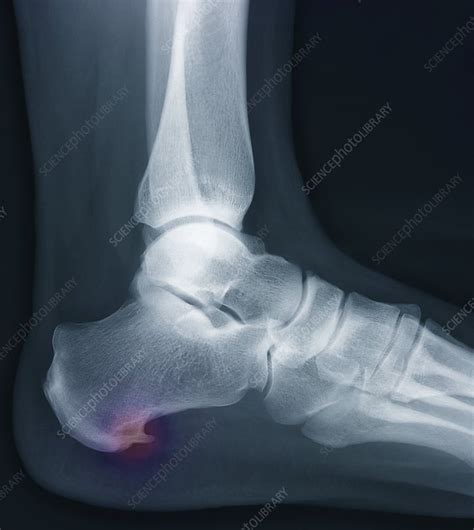 Heel bone spur, X-ray - Stock Image - C007/1907 - Science Photo Library